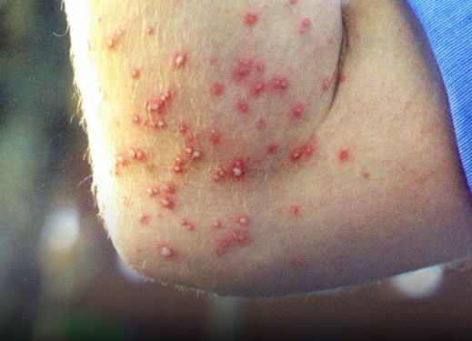 Red Imported Fire Ants can deliver painful stings